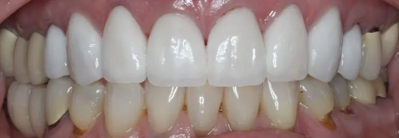 Patient's mouth after complete smile makeover