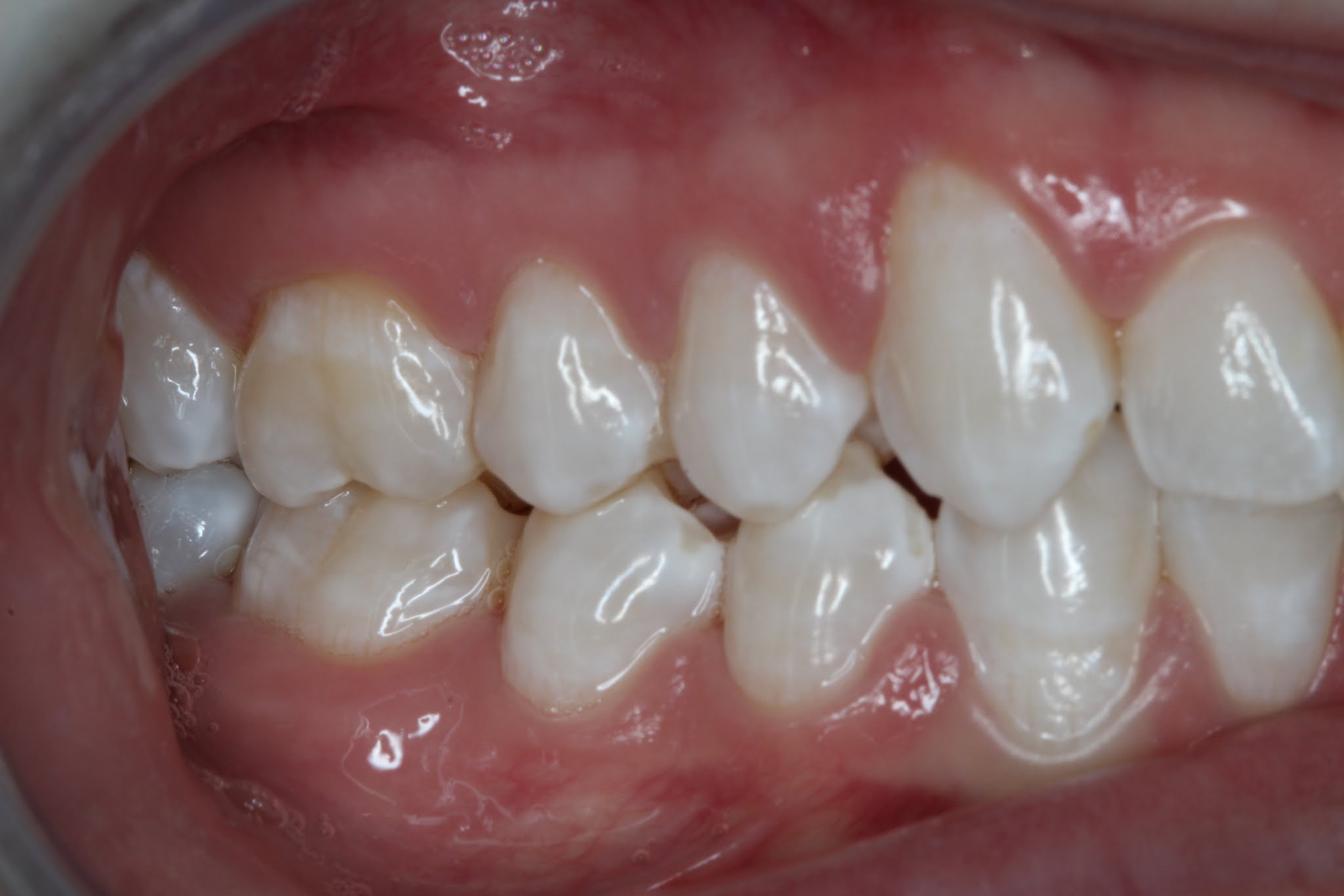 Patient's mouth before Invisalign