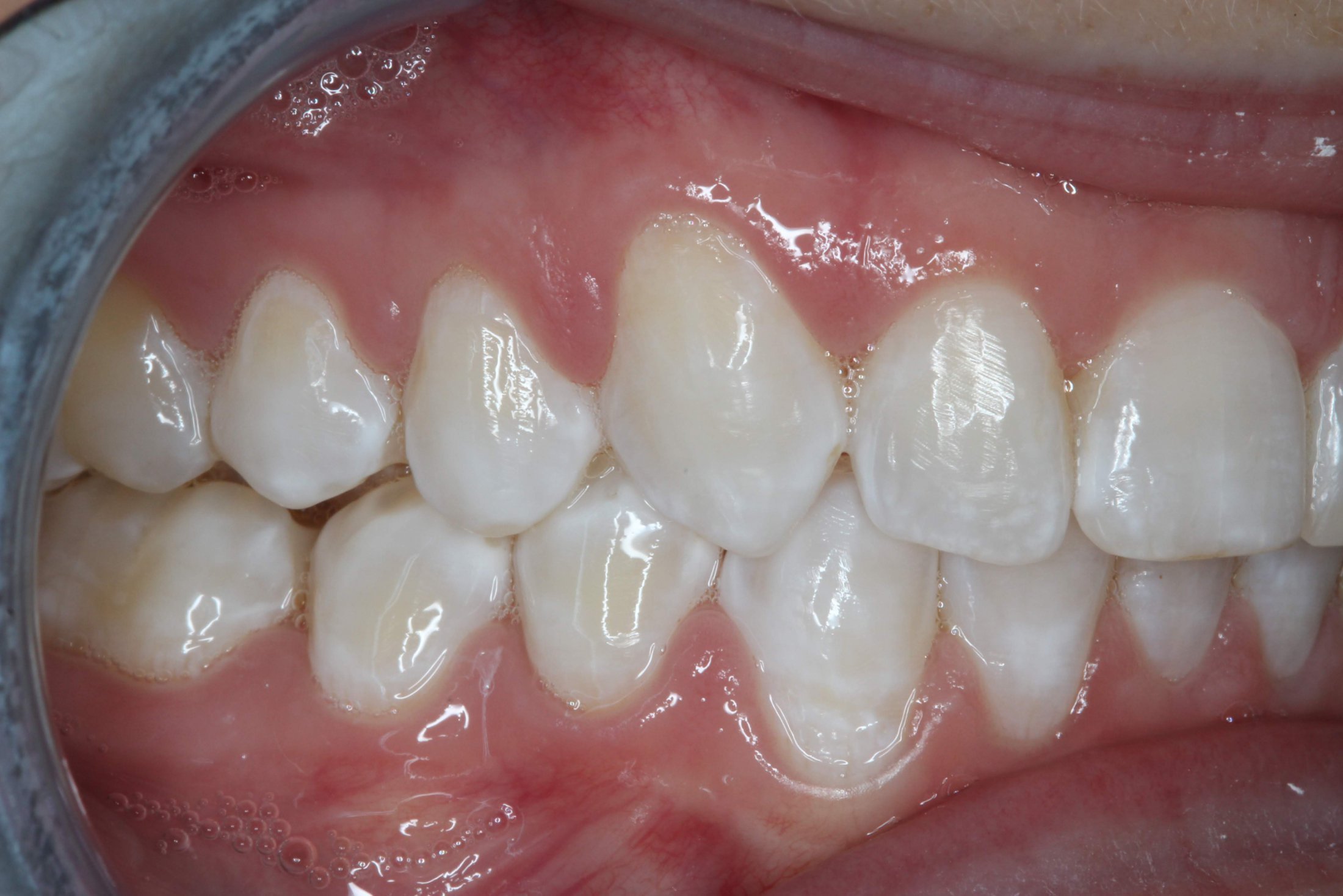 Patient's mouth after Invisalign