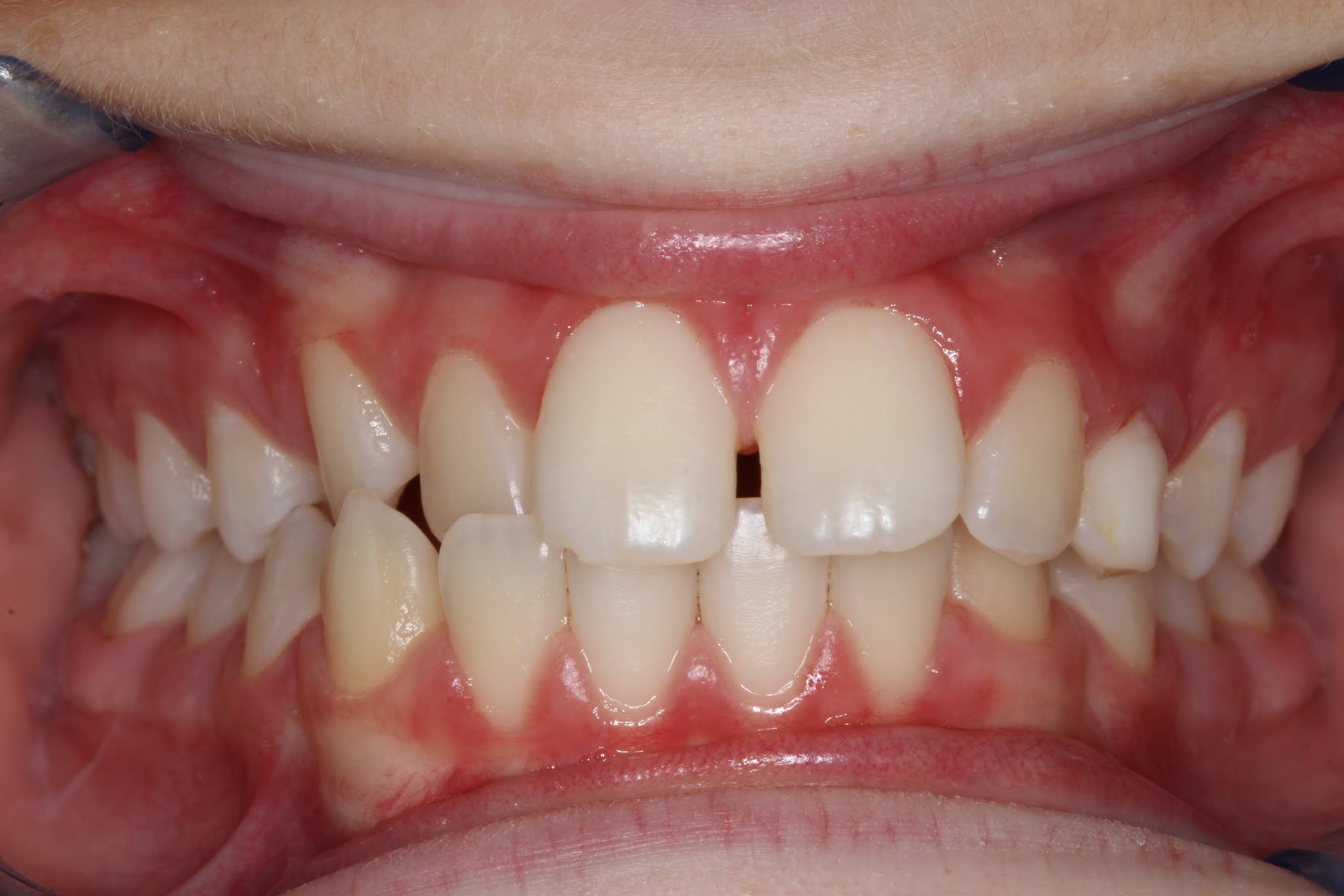 Patient's mouth before Invisalign