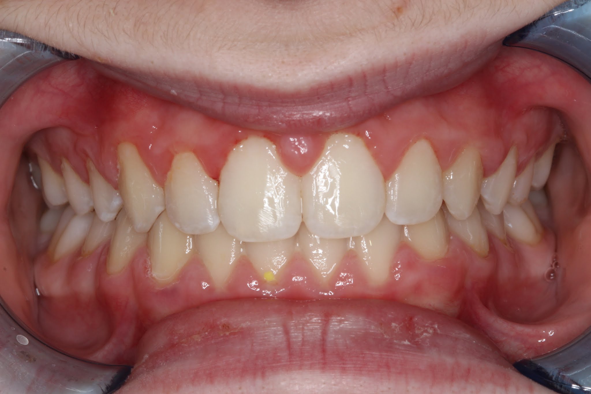 Patient's mouth after Invisalign