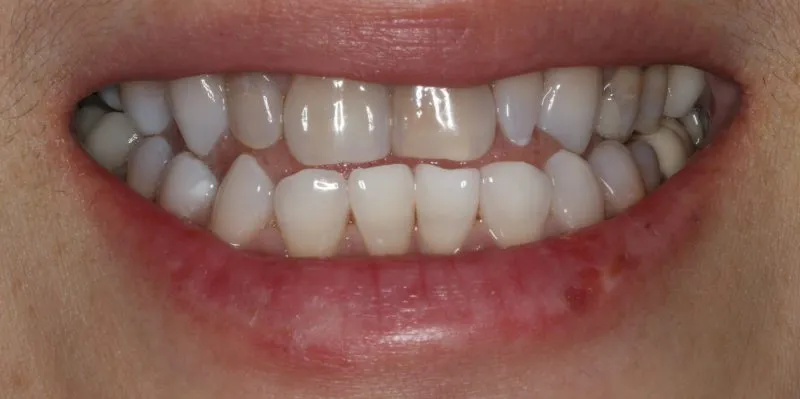 Patient's mouth before dental treatment