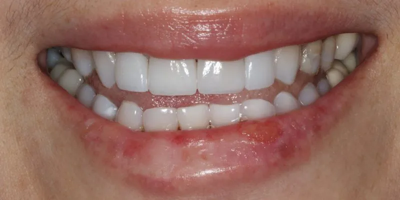 Patient's mouth after dental treatment