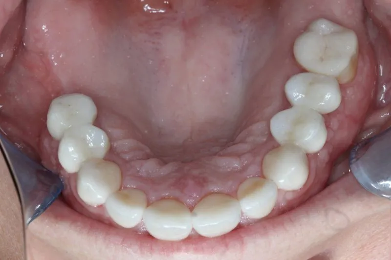 Patient's mouth after multiple implants