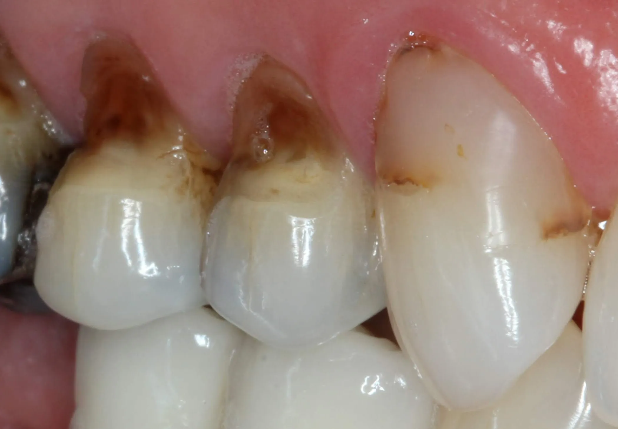 Patient's mouth before dental treatment