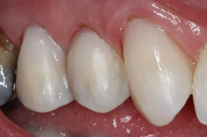 Patient's mouth after dental treatment