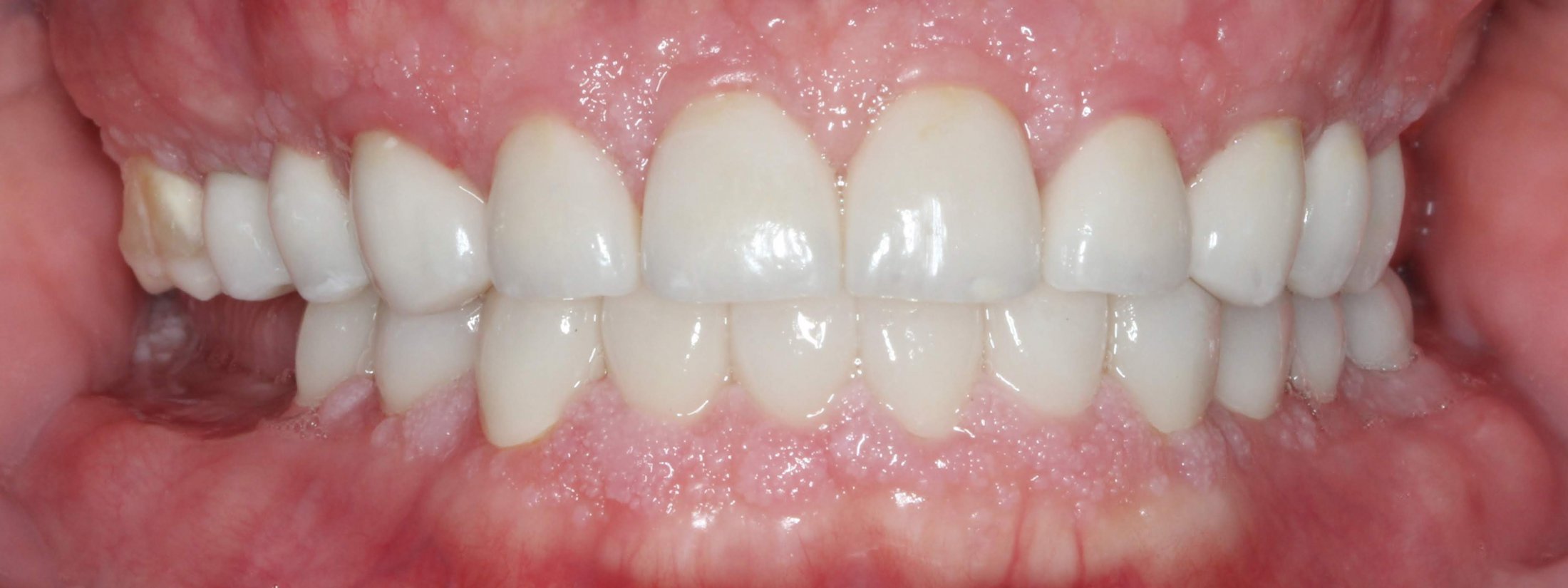 Patient's mouth after smile makeover