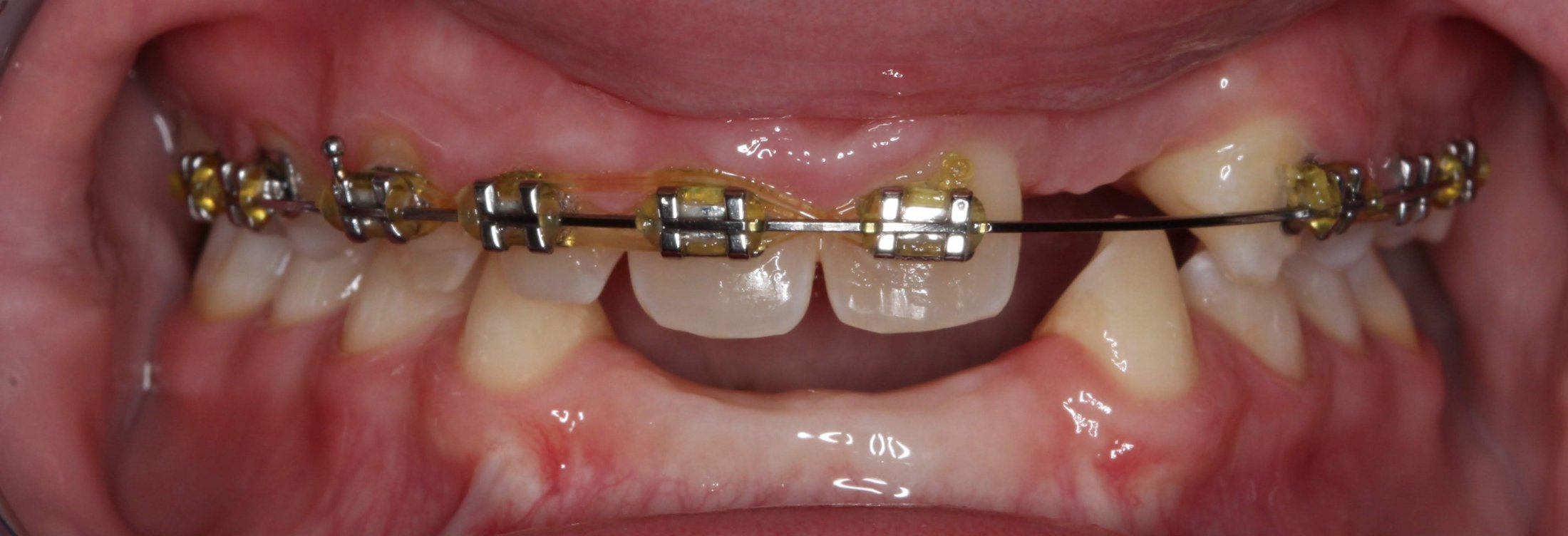 Patient's mouth before implants with braces
