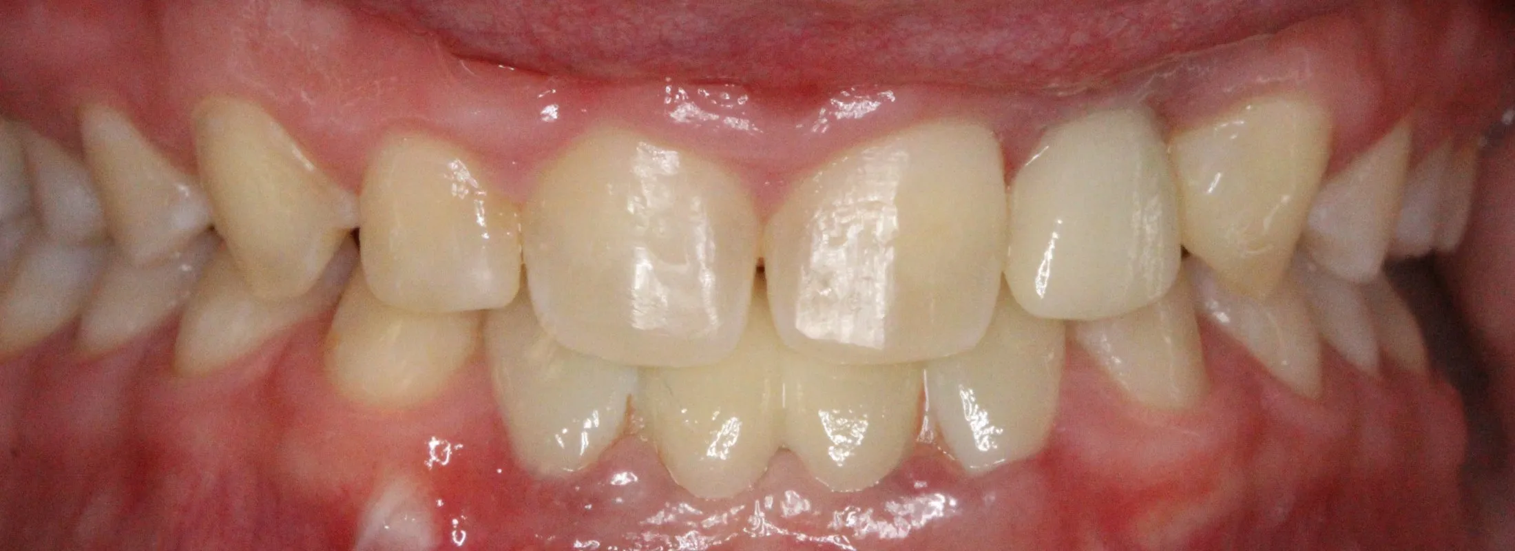 Patient's mouth with implants