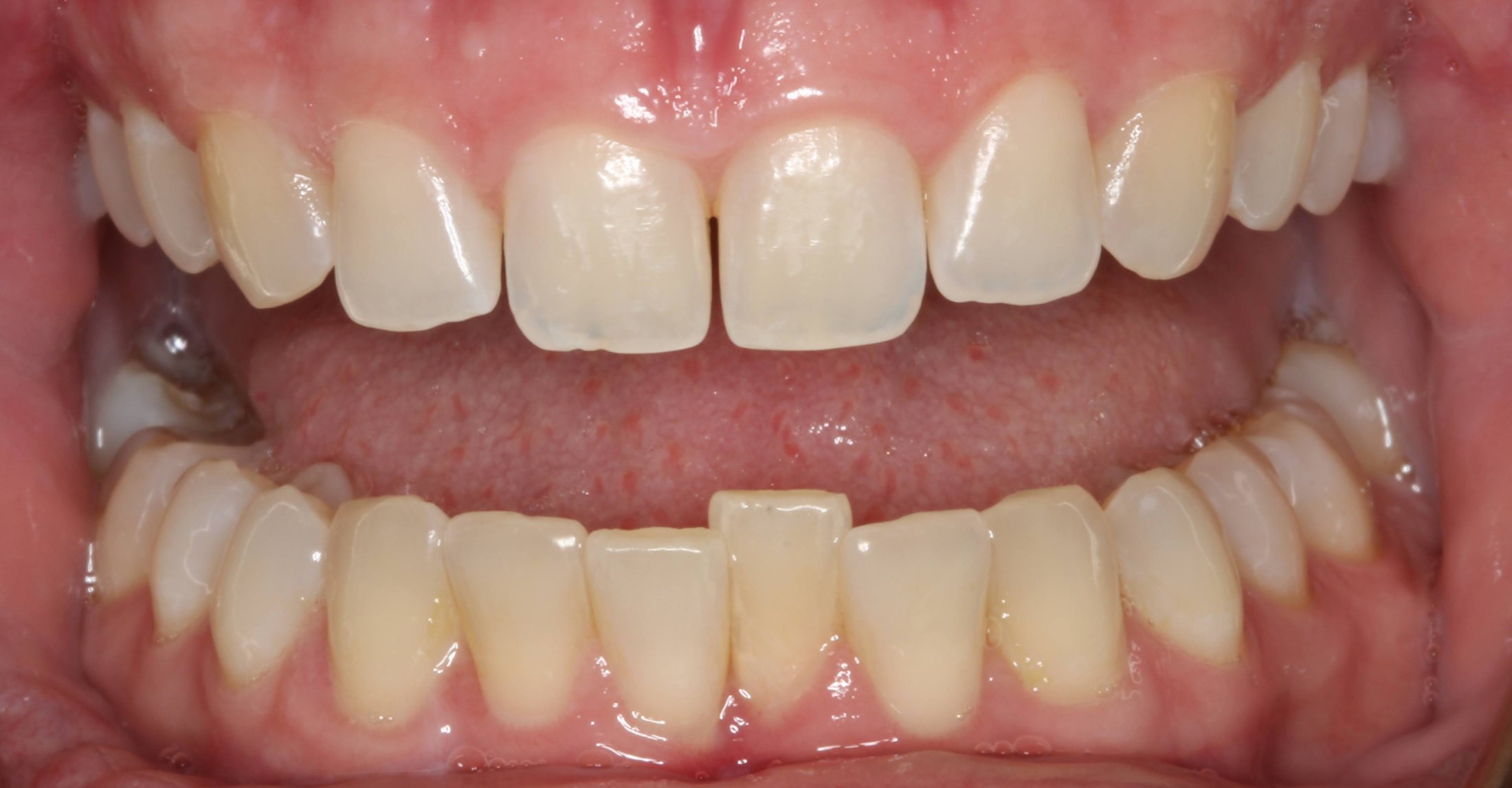 Patient's mouth before dental treatment - Invisalign