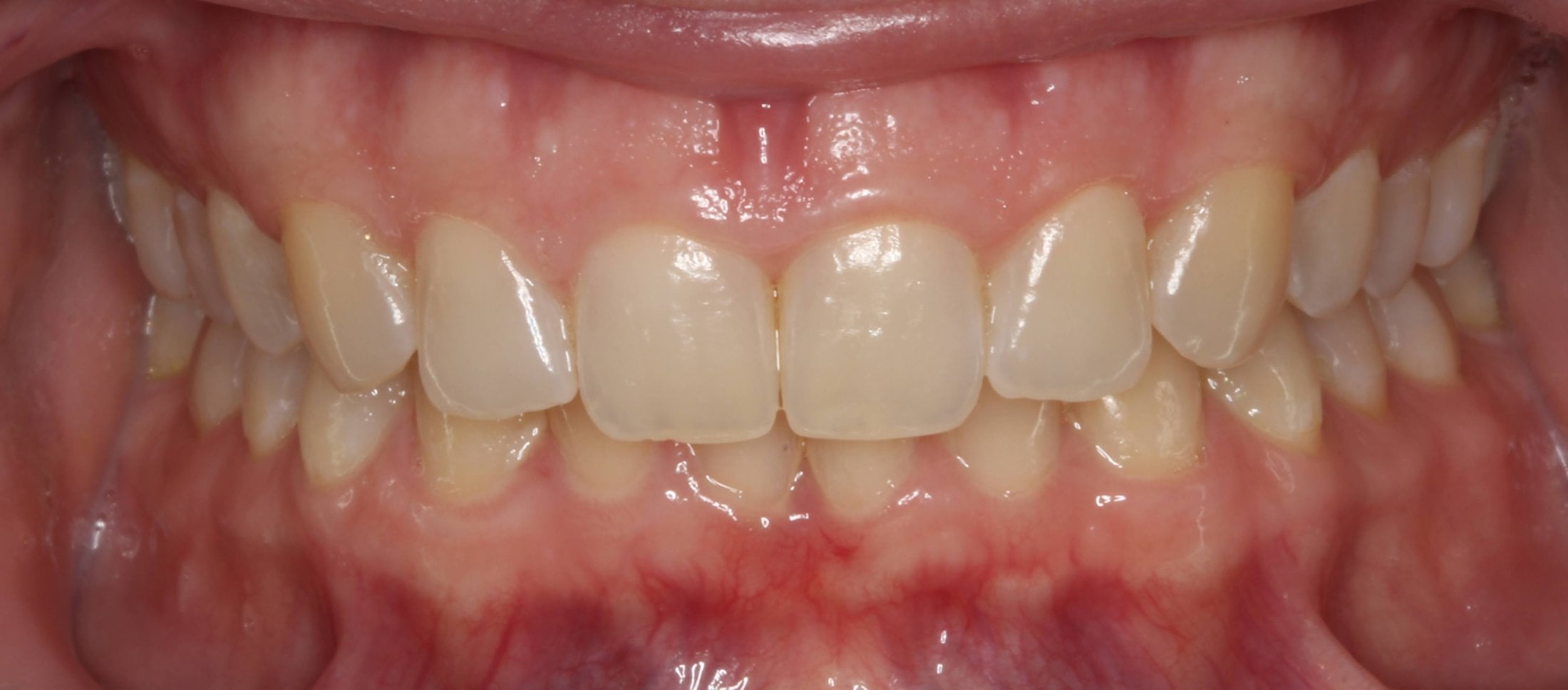 Patient's mouth after dental treatment - Invisalign