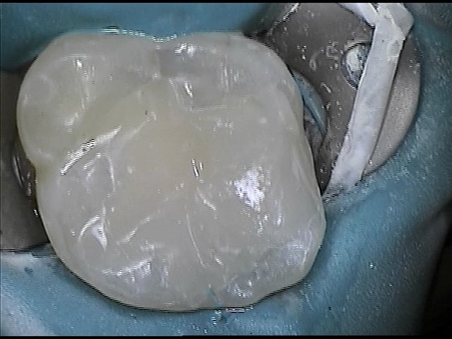 new composite filling placed