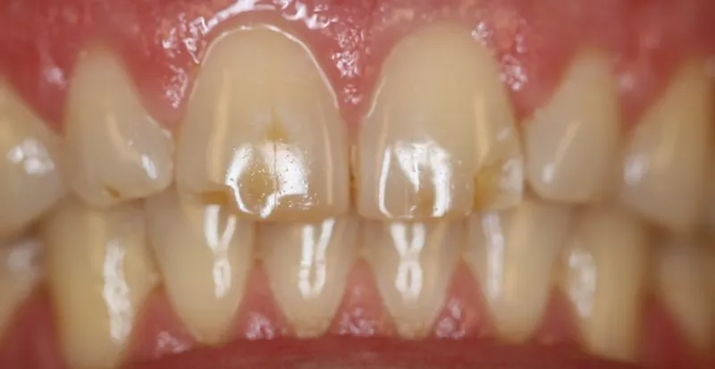 Patient's mouth before Zoom whitening