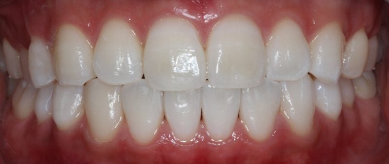Patient's mouth after Zoom whitening