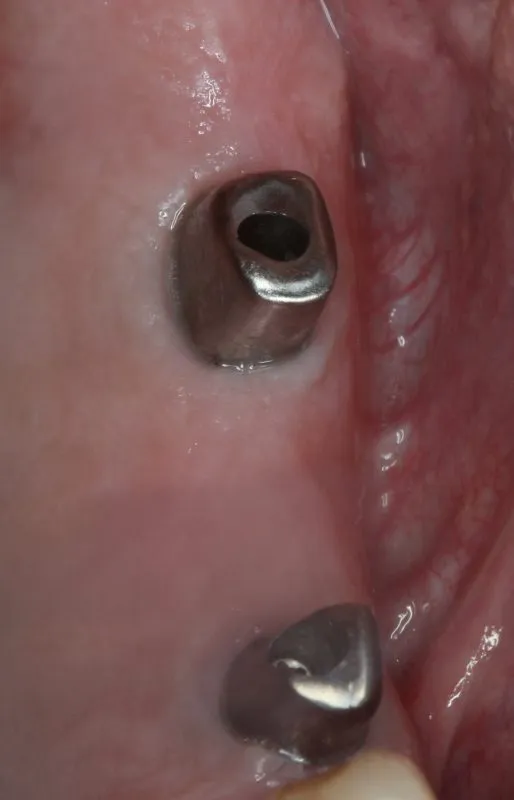 metal anchors for a posterior bridge