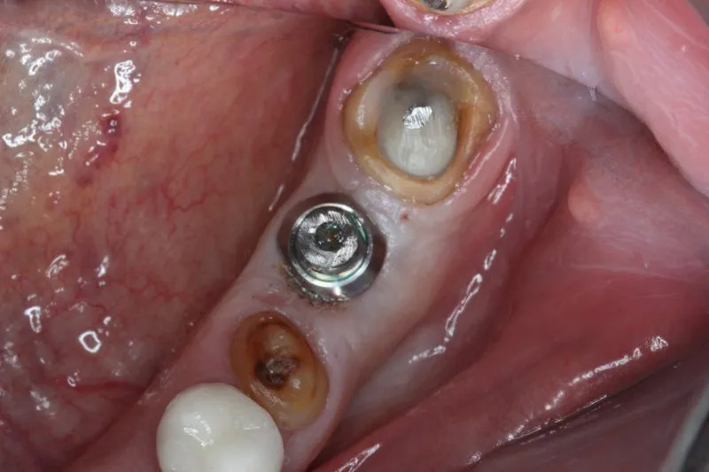 The patient’s mouth before the dental implants