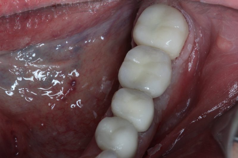 The patient’s mouth afteer the dental implants