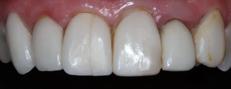 Patient's mouth before fixing cracked tooth
