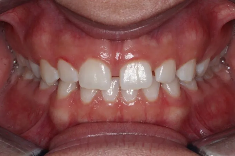 Patient's mouth before Invisalign