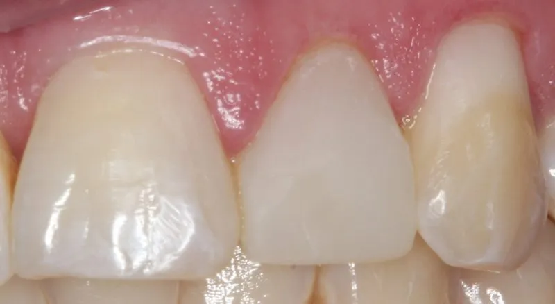 Patient's mouth after dental treatment on tooth