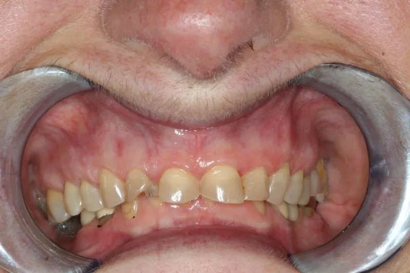 Patient's mouth before complete smile restoration