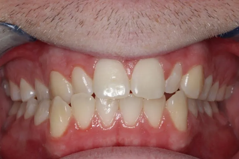 Patient's mouth before Invisalign