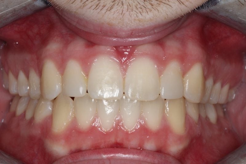 Patient's mouth after Invisalign