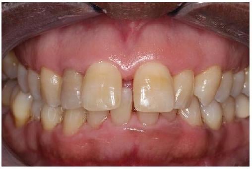 Patient's mouth before Invisalign