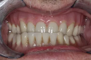 Patient's mouth before dental treatment
