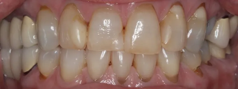 Patient's mouth before complete smile makeover