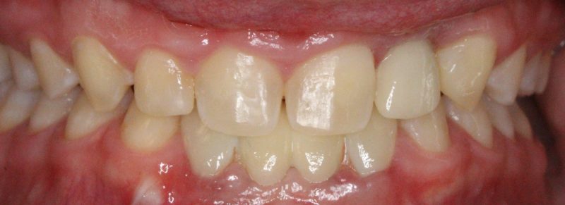 Patient's mouth with implants