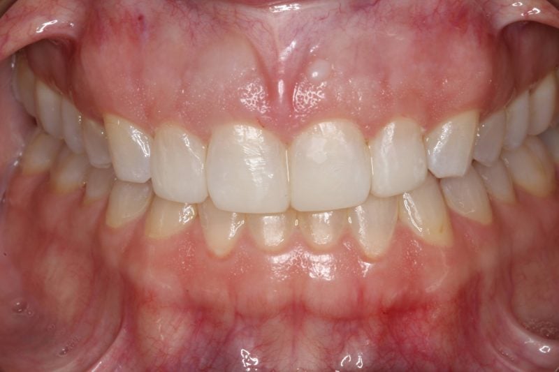 Patient's mouth before Invisalign