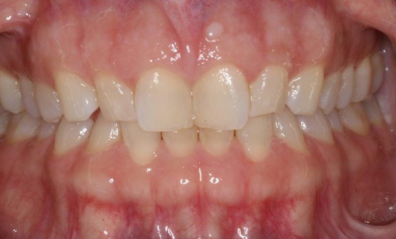 Patient's mouth before Invisalign