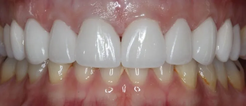 Patient's mouth after teeth whitening