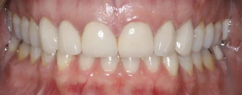 Patient's mouth before teeth whitening