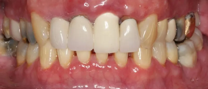 Patient's mouth before smile restoration