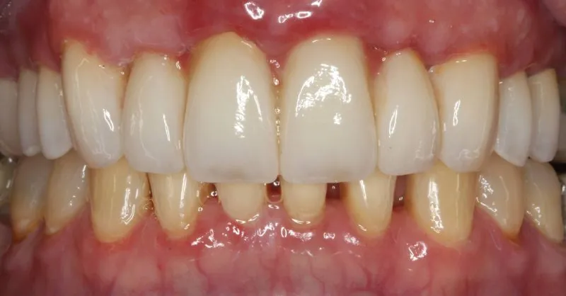 Patient's mouth before smile restoration