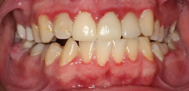Patient's mouth before comprehensive dental treatment correcting severe crowding and damaged teeth