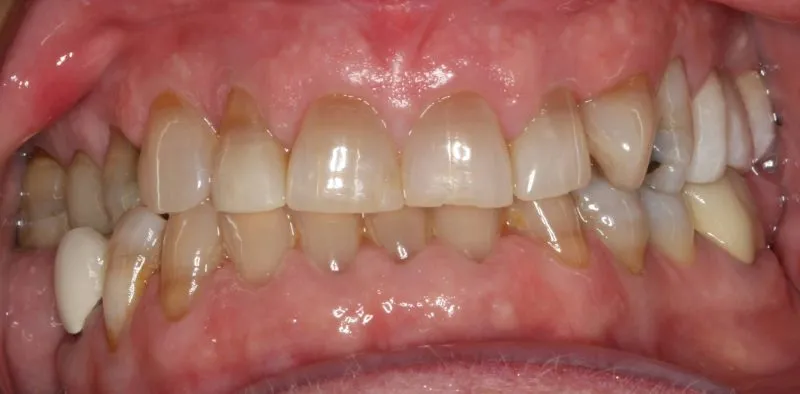 Patient's mouth before restorative dental treatment improving tooth alignment and function