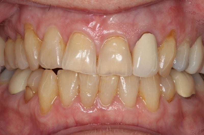 Patient's mouth before dental crown treatment restoring damaged and discolored teeth