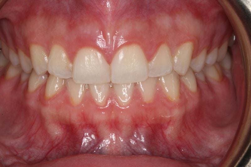 Patient's mouth before Zoom teeth whitening treatment correcting discoloration and enhancing smile brightness