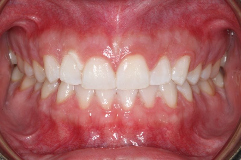 Patient's mouth after Zoom whitening treatment resulting in noticeably whiter teeth