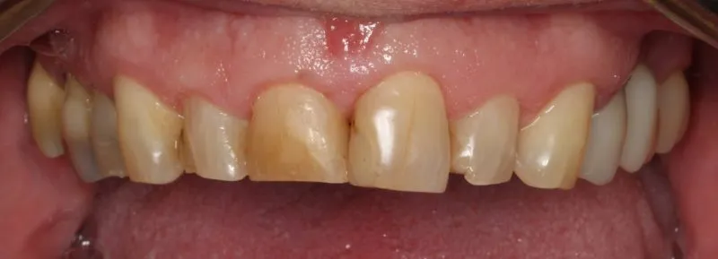 Patient's mouth before smile makeover treatment correcting discoloration and damaged teeth