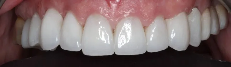 Patient's mouth after full smile restoration with dental crowns and veneers