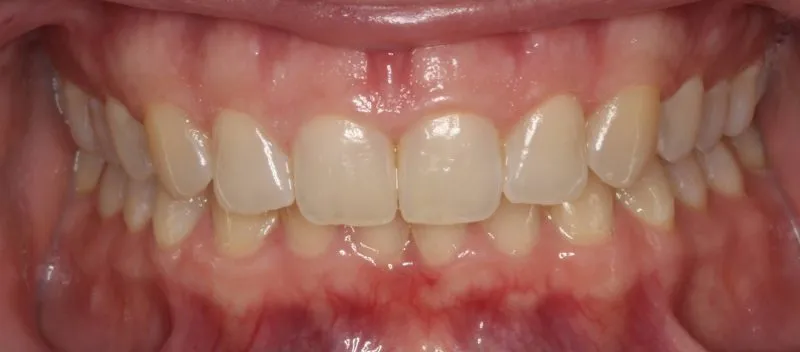 Patient's mouth after Invisalign treatment improving tooth alignment and creating a straighter smile