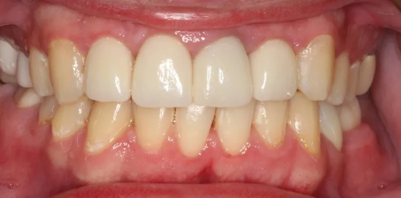 Patient's mouth after cosmetic dentistry treatment improving tooth color, shape, and smile aesthetics