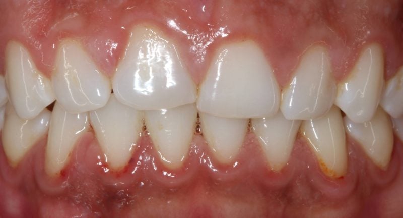 Patient's mouth before porcelain veneers treatment improving tooth shape, alignment, and smile aesthetics