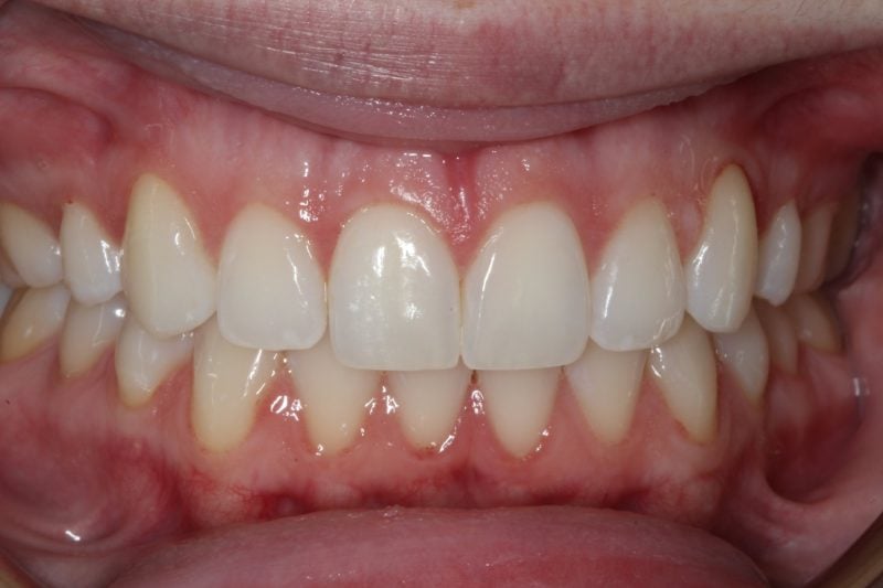 Patient's mouth before Zoom teeth whitening treatment showing a brighter and whiter smile