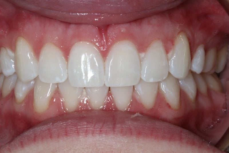 Patient's mouth after Zoom whitening treatment improving tooth color and overall smile appearance