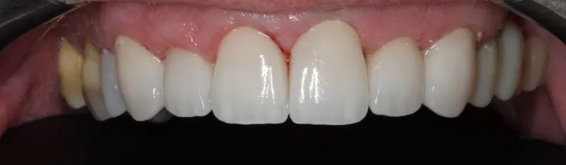 Patient's mouth after  cosmetic dental treatment with crowns and veneers enhancing smile appearance